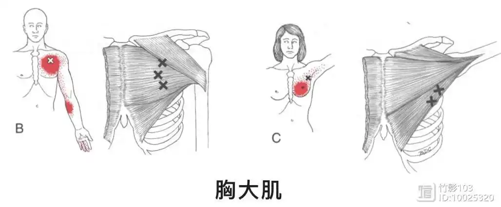 肌引起症状胸前痛肩前痛上肢内侧和手内侧疼痛扳机点有两个k1喙突到