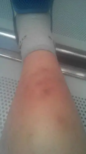 我右小腿皮下长了个长约8公分,宽约5公分的一个疙瘩,快俩年了,不痛,有