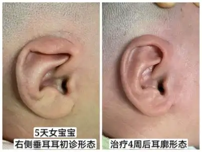 杯形耳,招风耳……这些耳形态畸形,宝宝出生后这个时间点矫正最适宜