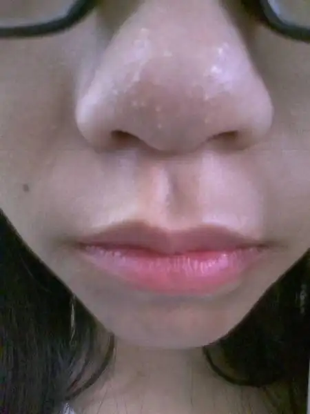 鼻子上有好几个白点,凸出来的那种,好像很小的时候就有了