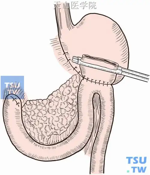 远端胃大部切除胃空肠billrothⅡ式吻合术 - 外科手术学 - 天山医学院