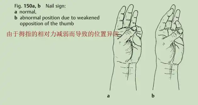 球状抓握:该动作测试拇指和手指屈曲的内收强度,从而允许评估正中神经