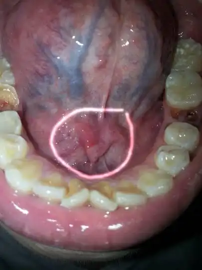 我舌头下面长了一个东西,请问这是什么,应