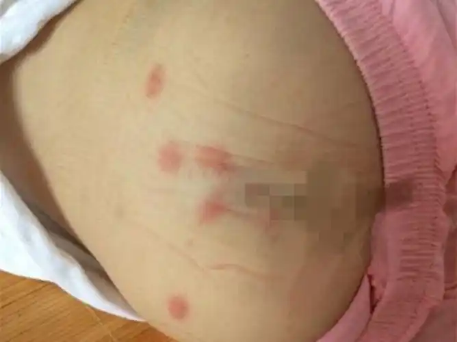 ④如果是女孩子,隐私处还有可能会出现不明分泌物,感觉到瘙痒等情况.