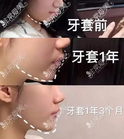 骨性凸嘴和齿性凸嘴区别对比如何区分凸嘴是骨性还是牙性