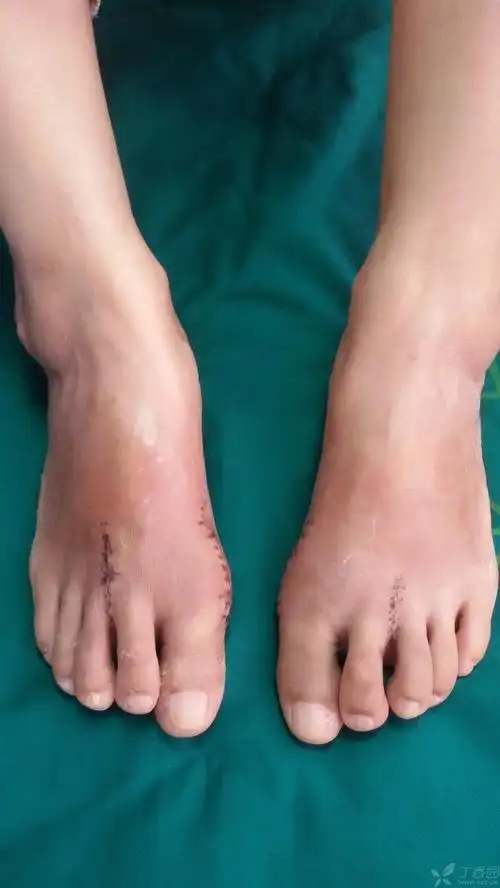 跖趾关节置换(山大二院)