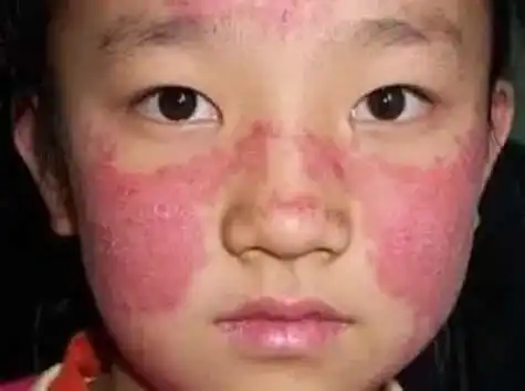 蝶形红斑艾灸的正确方法和穴位