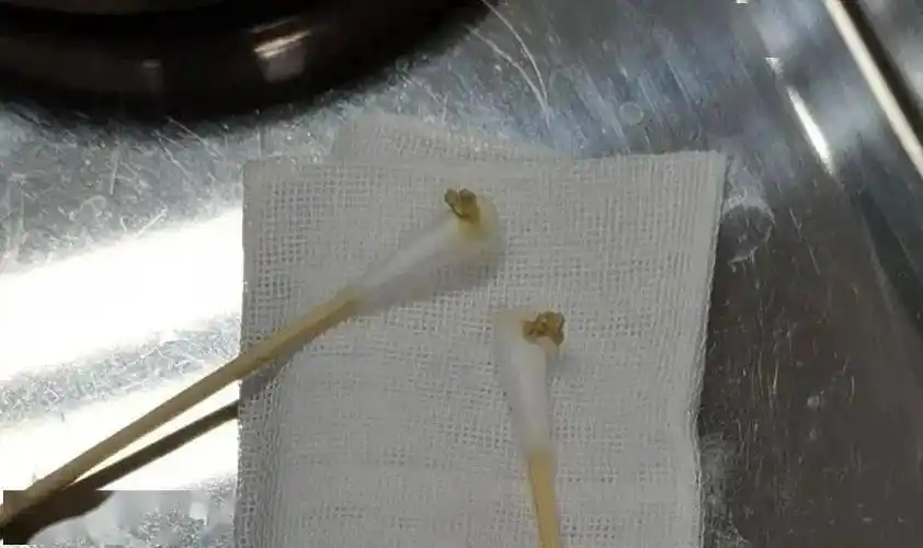 杭州大伯眼睛流脓3年不愈!医生从他眼里挑出多颗"石头"