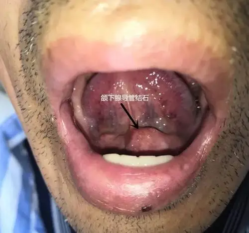 根据进食时肿胀伴发疼痛的特点,导管口溢脓及触诊时触及导管内结石等