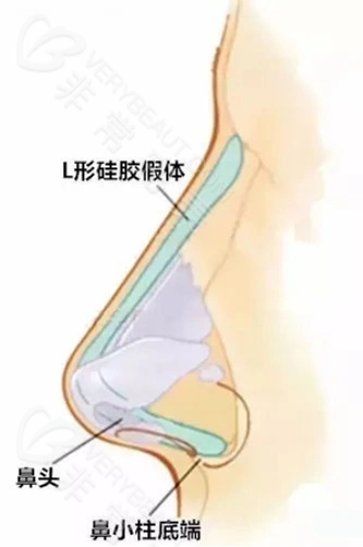 硅胶假体隆鼻会移位吗?