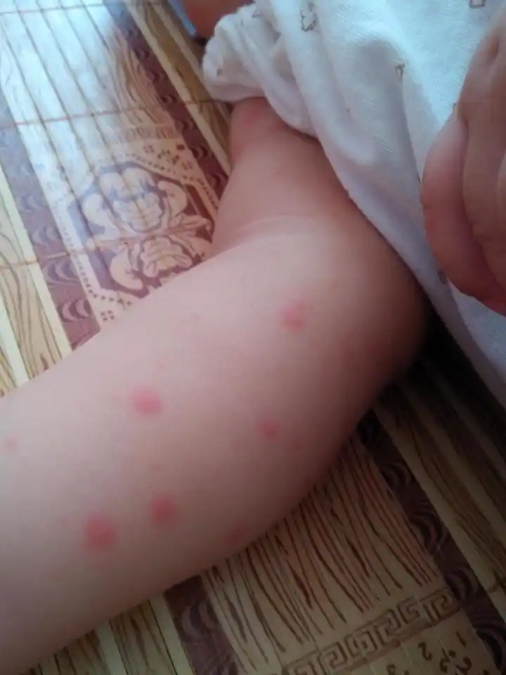 浏览  33333  推荐回答 你好,这种情况考虑是局部皮肤潮湿所致的湿疹