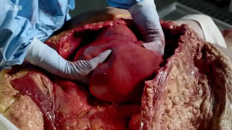 解剖尸体法医是如何解剖尸体的呢法医尸体解剖全过程解密