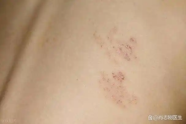 带状疱疹,湿疹,用什么药好得快?听听医生怎么说