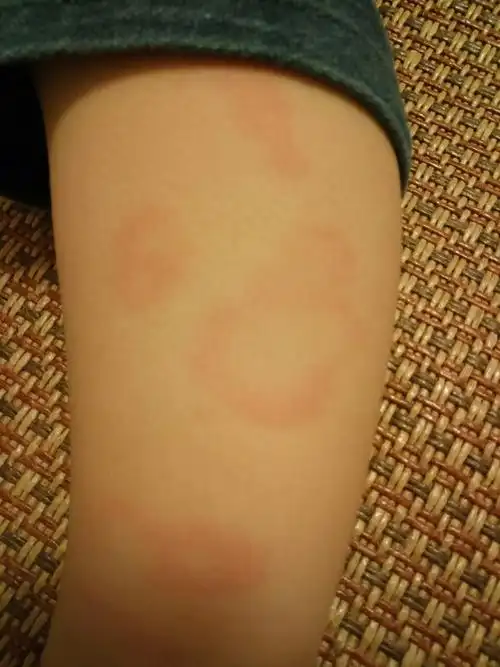 宝宝腿上出现红色圈圈中间是皮肤色,这是什么?