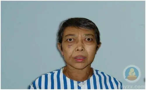 中医怎样治疗甲减