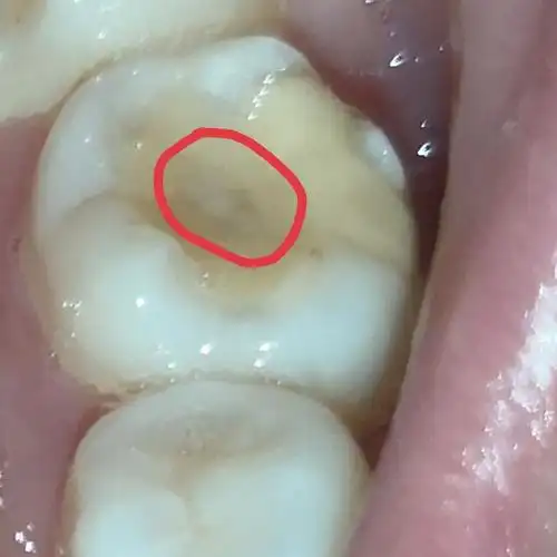 请问这个是继发龋吗?要再补牙吗?