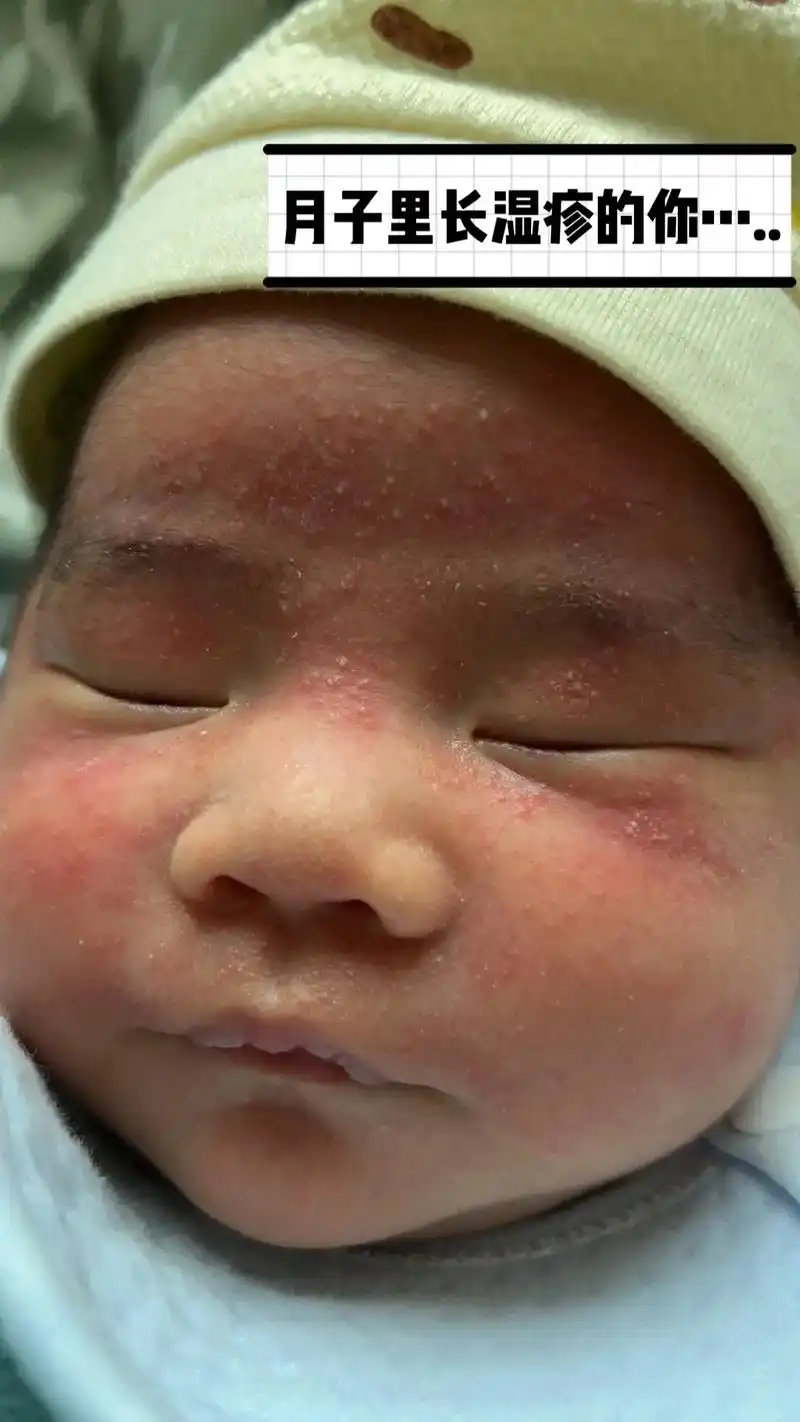 婴儿长湿疹真心很可怕,主要是孩子受罪.在月子里就开始长湿疹, - 抖音