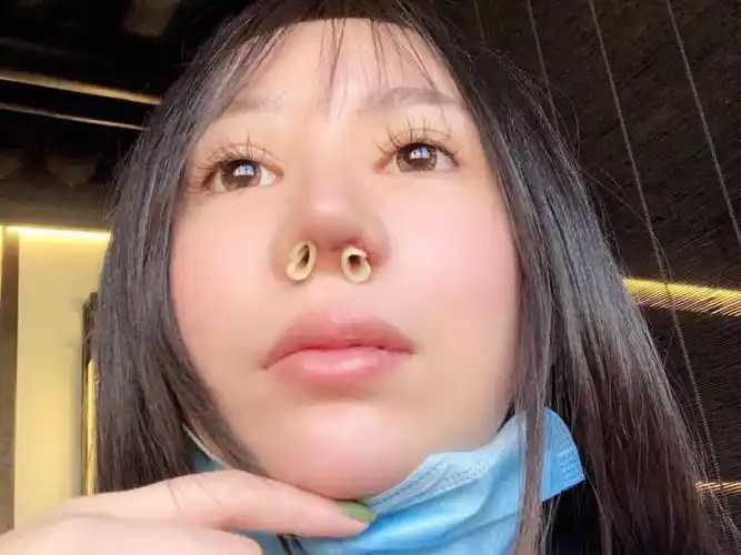 小姑娘之前在外院做了46615次隆鼻,导致鼻孔一大一小_圈子-新氧