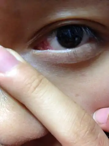 泪阜,泪囊,眼角内红肿,很痒,有图片,请问一下这是怎么了,有5,6天了.