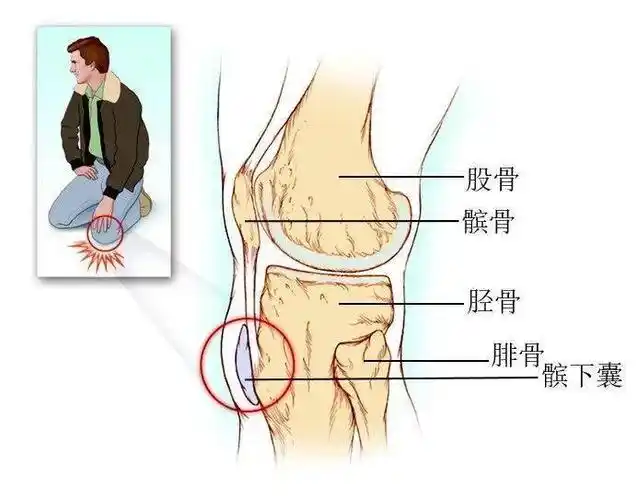 线上问诊髌下滑囊炎
