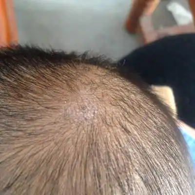 宝宝七个月了,头上长了可多干皮,一片一片的,脖