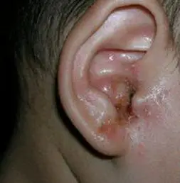 耳鼻喉医话| 耳朵也会长湿疹?耳朵反复瘙痒怎么办?_手机搜狐网