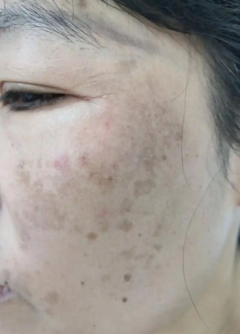 面部黄褐斑.经过一段时间的治疗后效果不错.逐渐变好中#美容