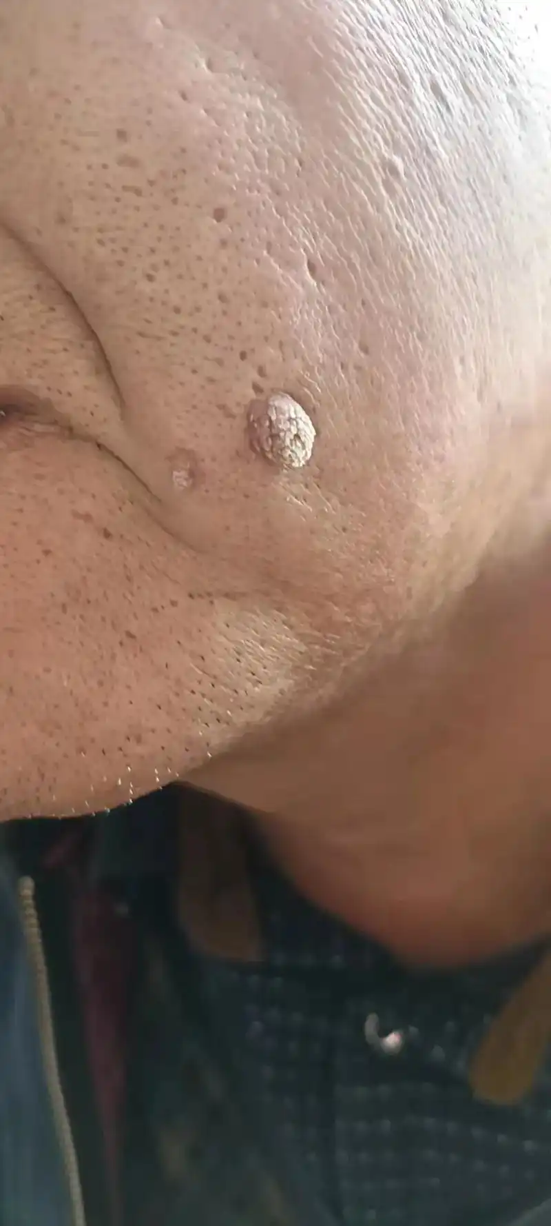 寻常疣可以长在任何位置形态也都不太一样