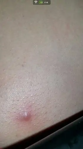 屁股坐下接触部位有这样一个红疙瘩 很痛 求解决办法!