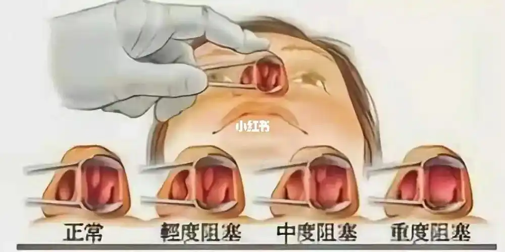 怎么判断自己是否患有鼻甲肥大 466个症状帮您认清鼻甲肥大: 1,持续