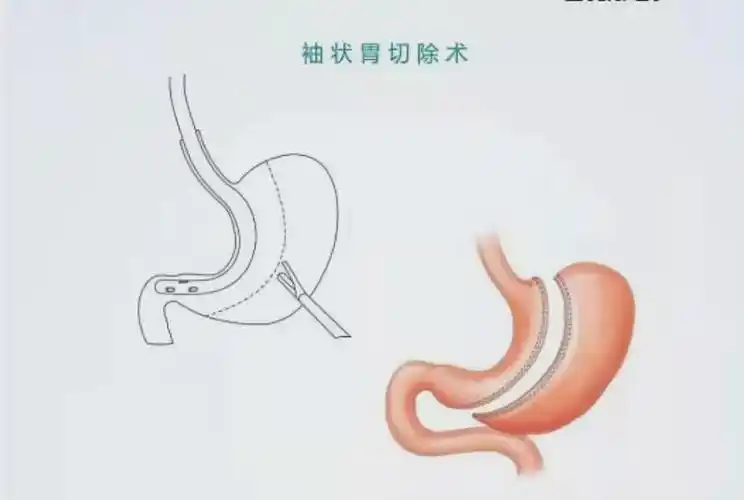 罗山县中医院成功开展首例腹腔镜下袖状胃切除术