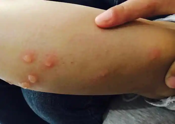 其它 六岁孩子突发皮疹 写美篇6月3曰众多全科医生:荨麻疹,湿疹,过敏