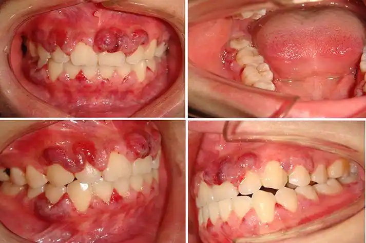 牙龈炎图片_有来医生