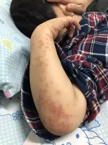 5岁娃娃全身皮疹,原来是新型手足口病!家长注意!