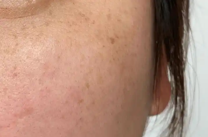 夏天又来了注意防晒防止晒斑