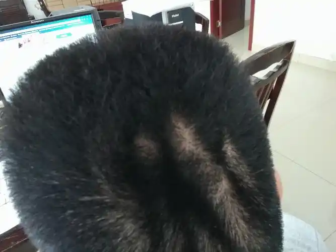 有三四年了之前没有脑后竖向三条棱不痛不痒手摸头皮凹凸