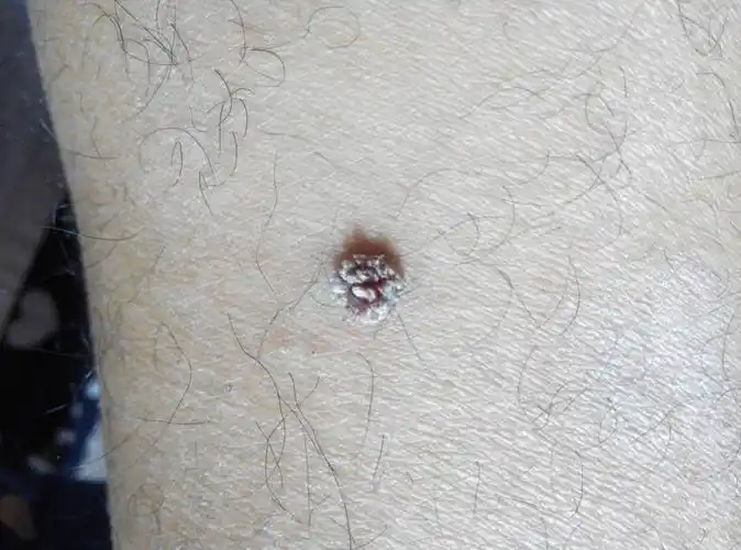 长在小腿上不疼不痒,跟花一样有很多瓣.