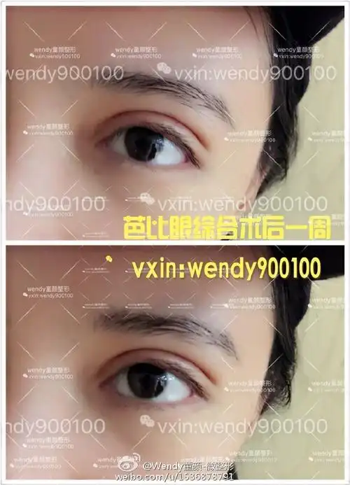 芭比平行双眼皮95一周拆线恢复的很好[愉快]8mm欧式芭比眼.