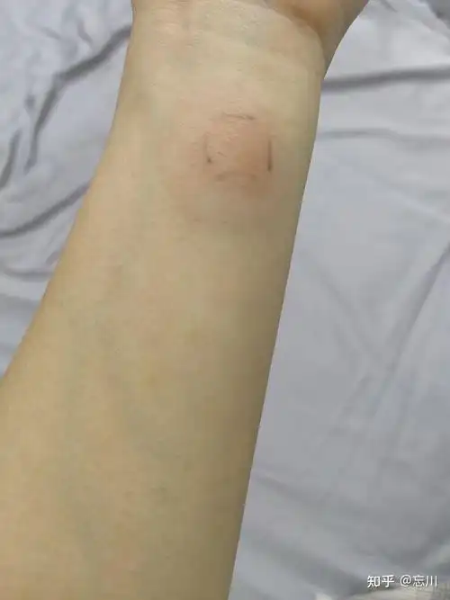 做完ppd48小时以后这样正常吗