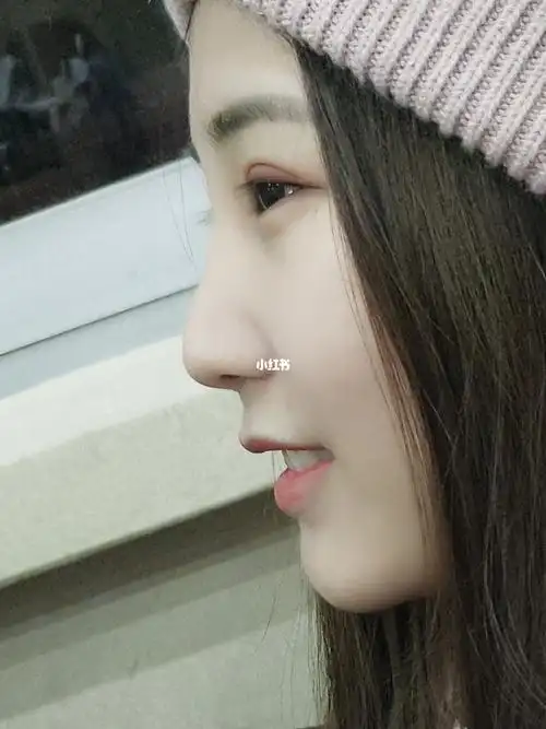 隆鼻修复 膨体单独取出_隆鼻_鼻综合_积雪草_消肿_耳软骨鼻综合_美妆