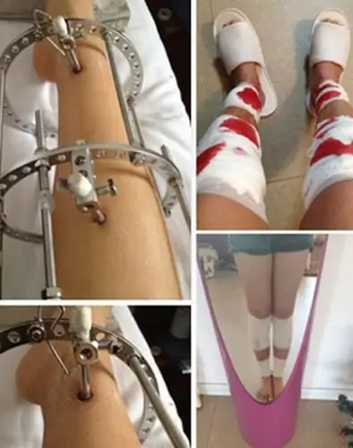 成人o型腿怎么矫正图解图片