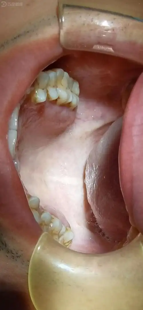 张口受限,呈大面积白色的改变可能是口腔粘膜下纤维化惹的祸