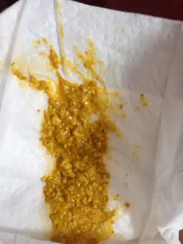 宝宝有两个月混合喂养,已有10多天拉出的便便有奶瓣,这是消化不良的