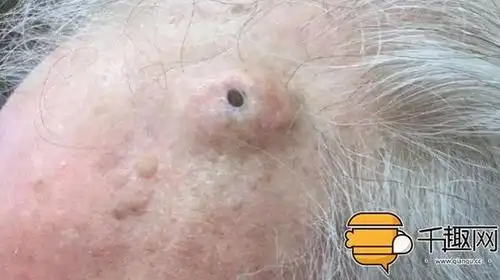 医生挤出十年大黑头,拔出瞬间高潮