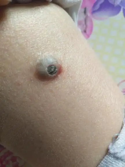 腿上长个包,就像火山口一样,里边包着个黑色的硬硬的东西,有的时候会