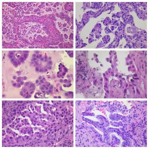 腺癌是恶性上皮肿瘤的一种,癌细胞类似腺体的细胞,如肺内分泌粘液的