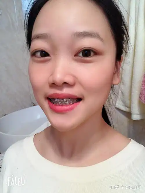 24岁带上牙套的日子