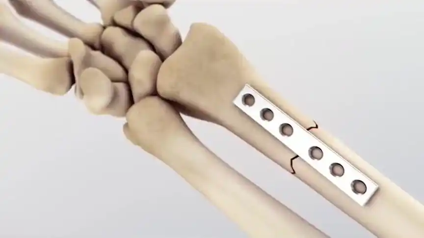 骨折后打的钢板,为什么不能超过三年时间?听听医生怎么说