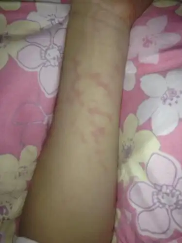 睡觉醒来发现手臂上有红印,不疼不痒,怎么回事啊,求解答!