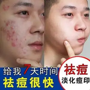 男士祛痘印去豆